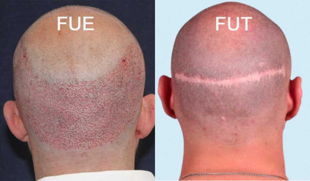 FUE Hair Transplant