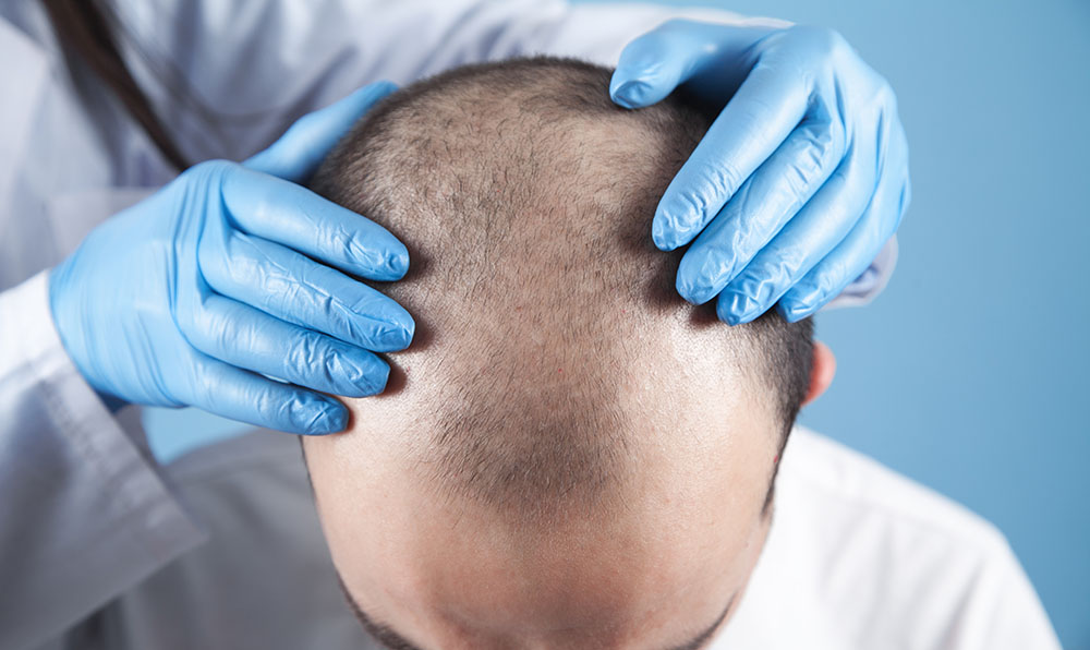 Grafts in Hair Transplants